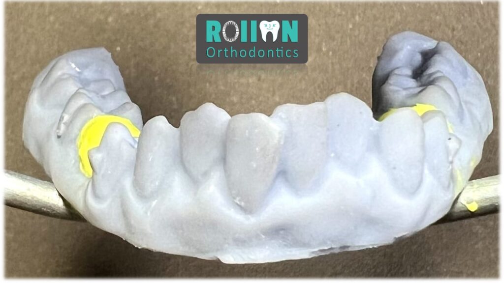 Rollon Orthodontics 3