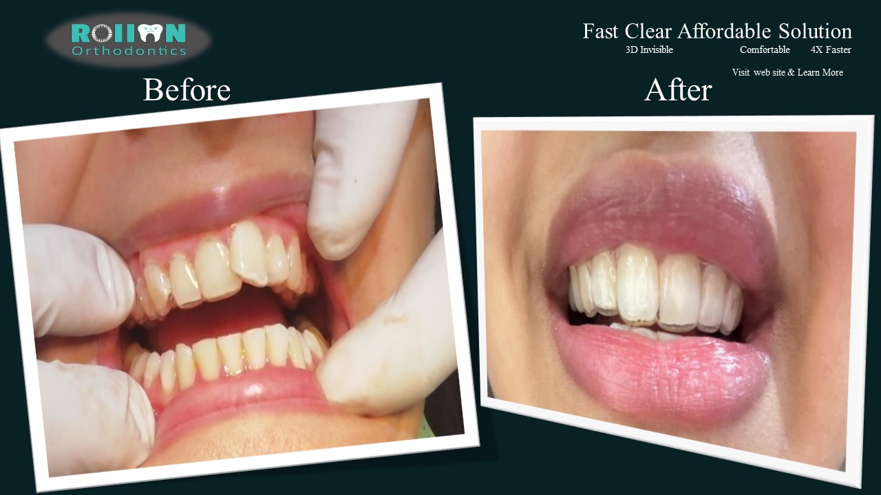 Rollon Orthodontics for web