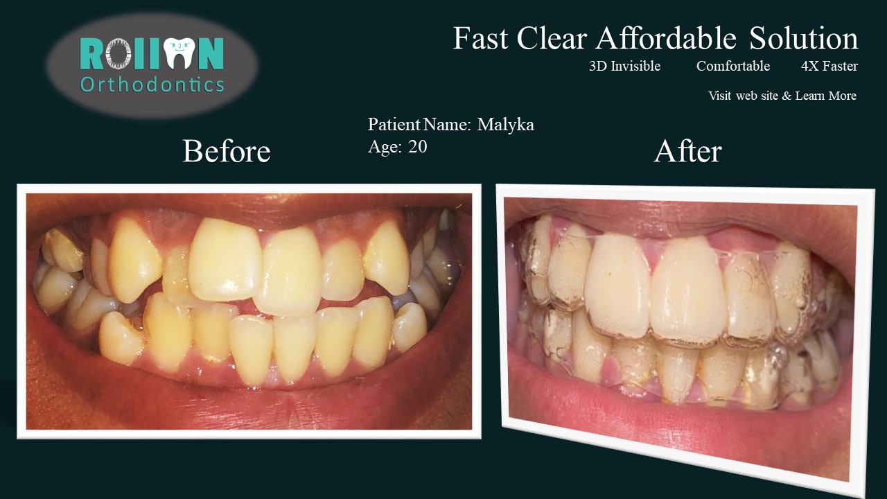 Rollon Orthodontics Patient